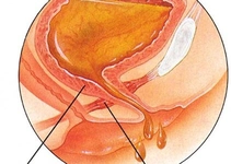 Mesane İltihabı Belirtileri ve Tedavisi