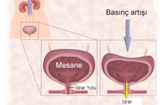 Hiperaktif Mesane