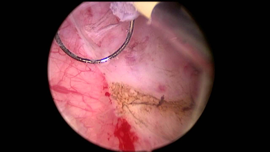 Mesane Kanseri Ameliyatı Riskleri ve Sonrası