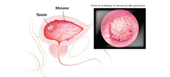 Mesane Kanseri