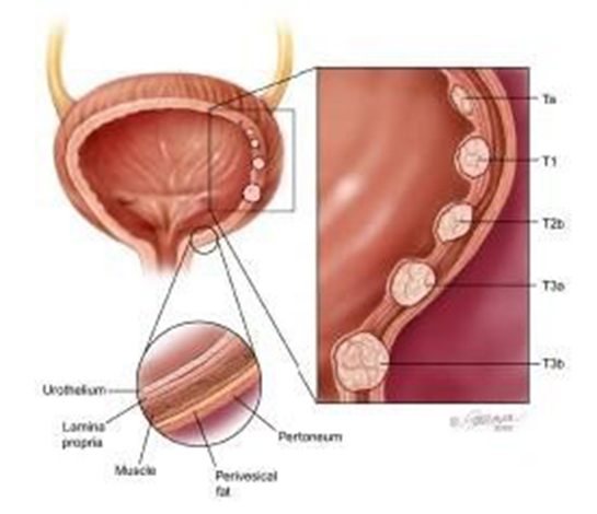 Mesane Malign Neoplazmı Belirtileri ve Tedavisi