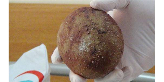 Mesane Taşı Ameliyatı Riskleri ve Sonrası