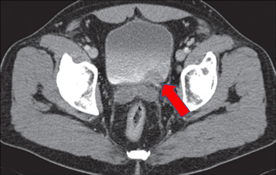 Mesanede Kist Belirtileri ve Tedavisi